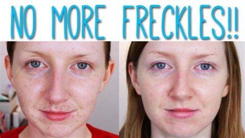 Can you remove freckles?
