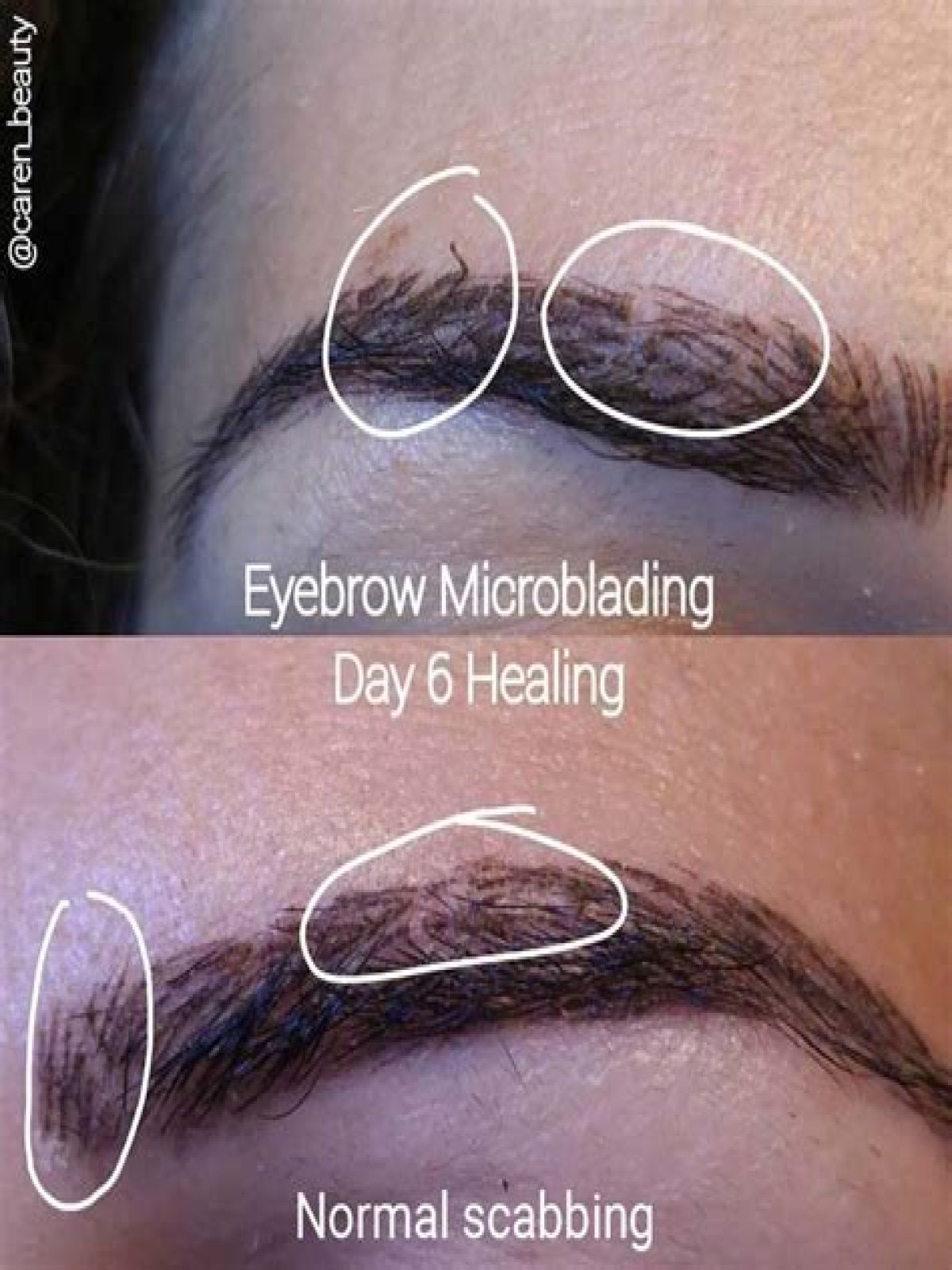 Does tattooing eyebrows stop hair growth?