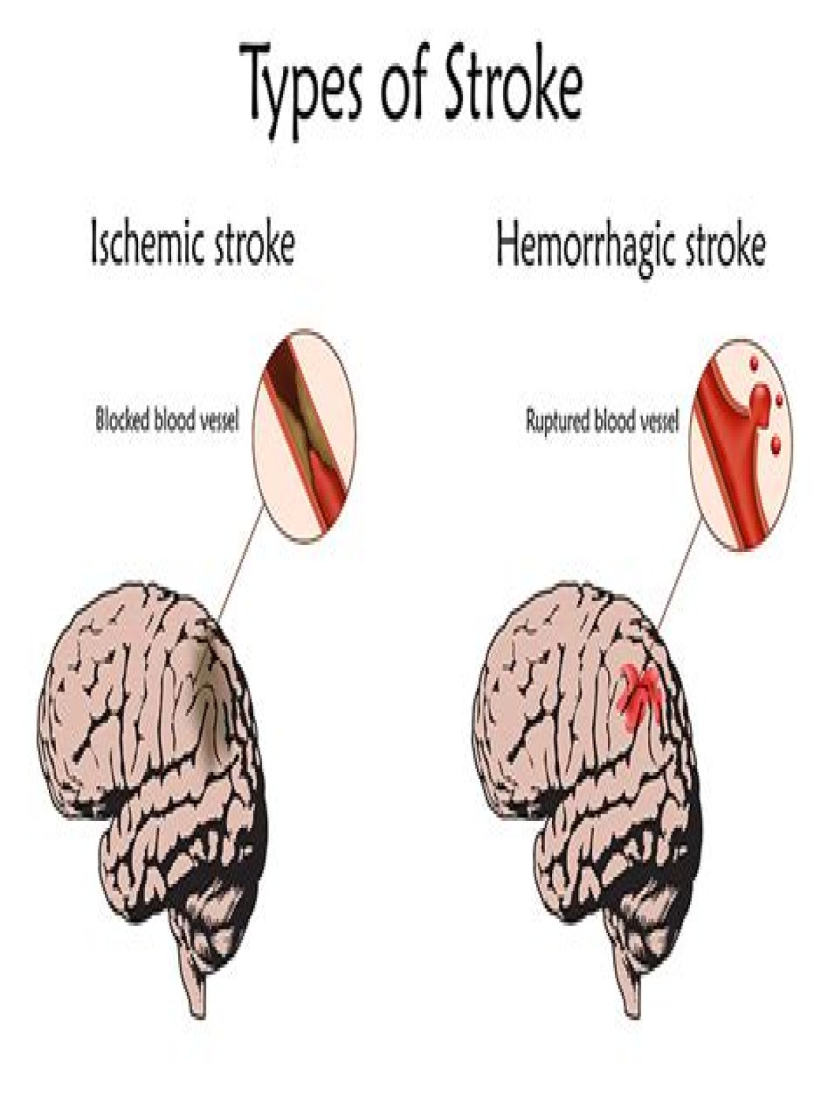 Is a mini stroke serious?