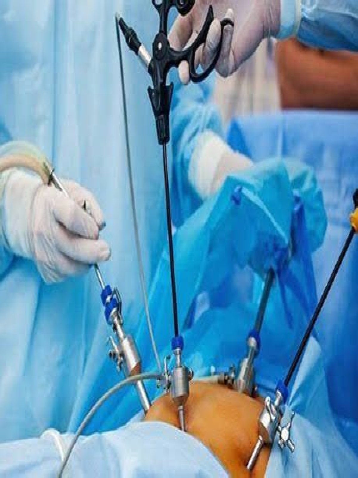 Is laparoscopy safer than open surgery?
