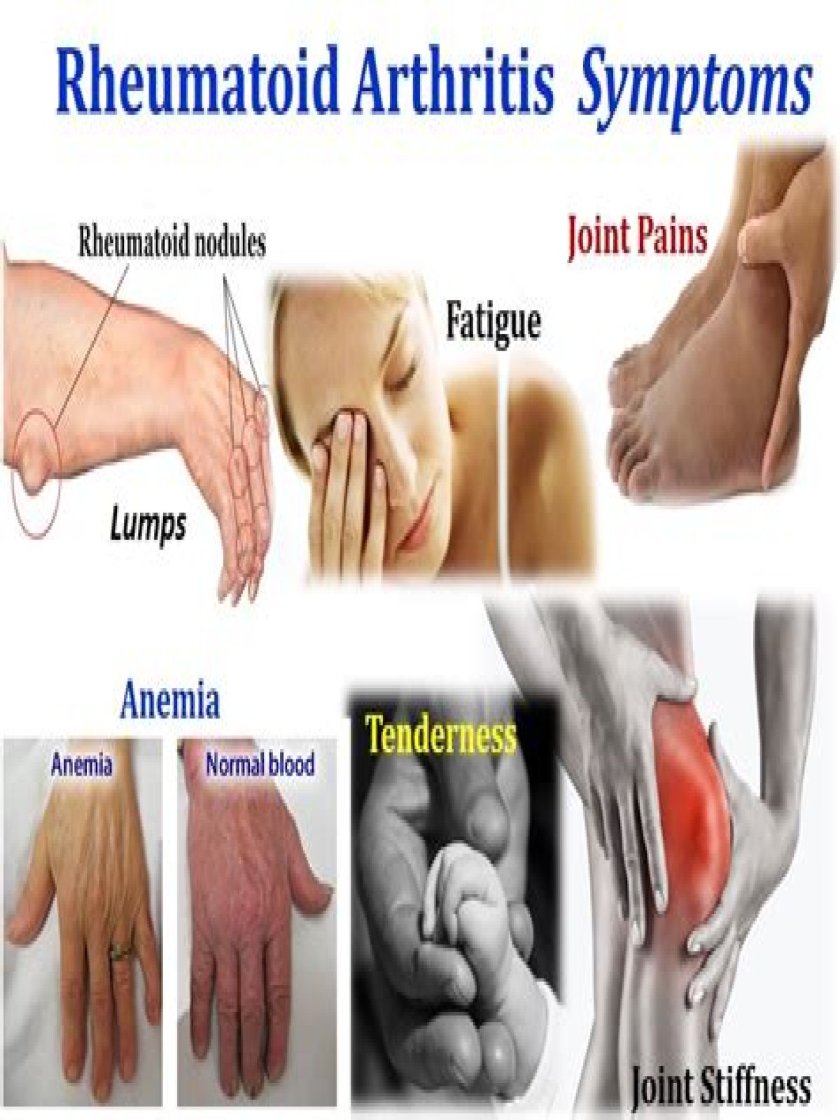 What are the symptoms of arthritis in the legs?