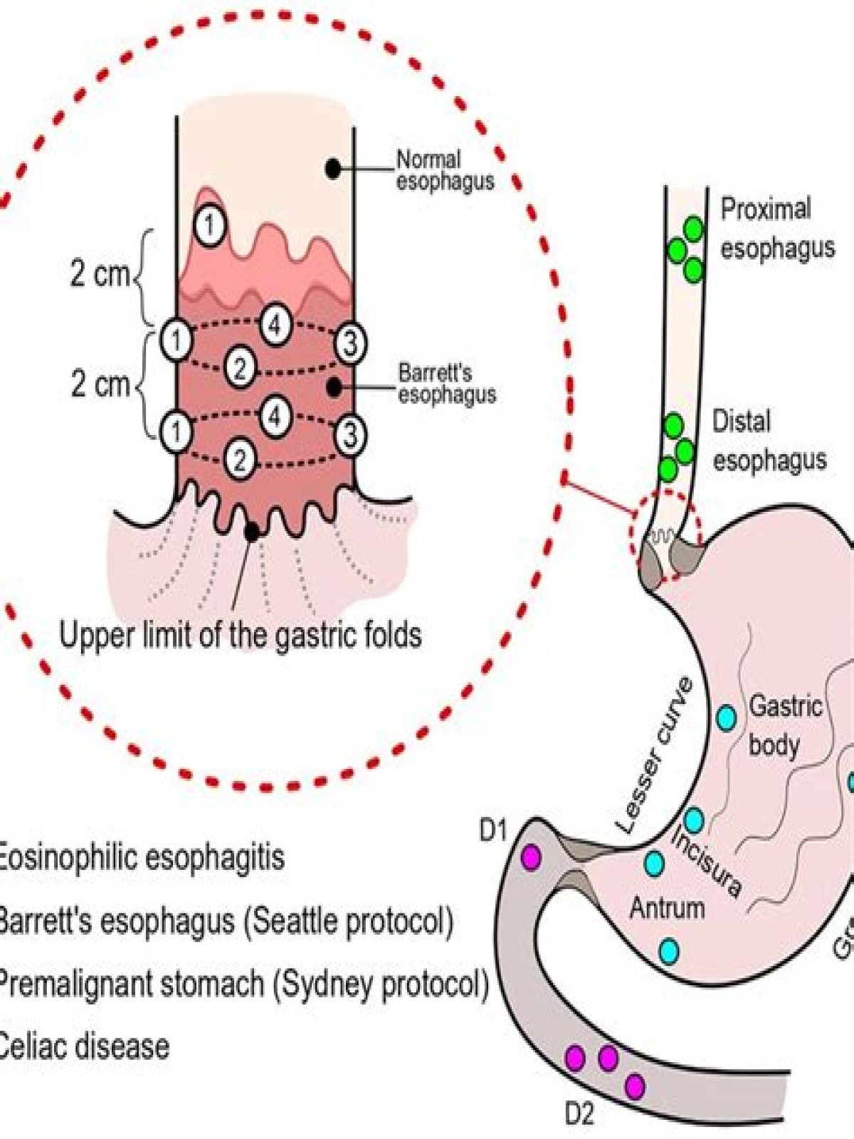 What is duodenal biopsy