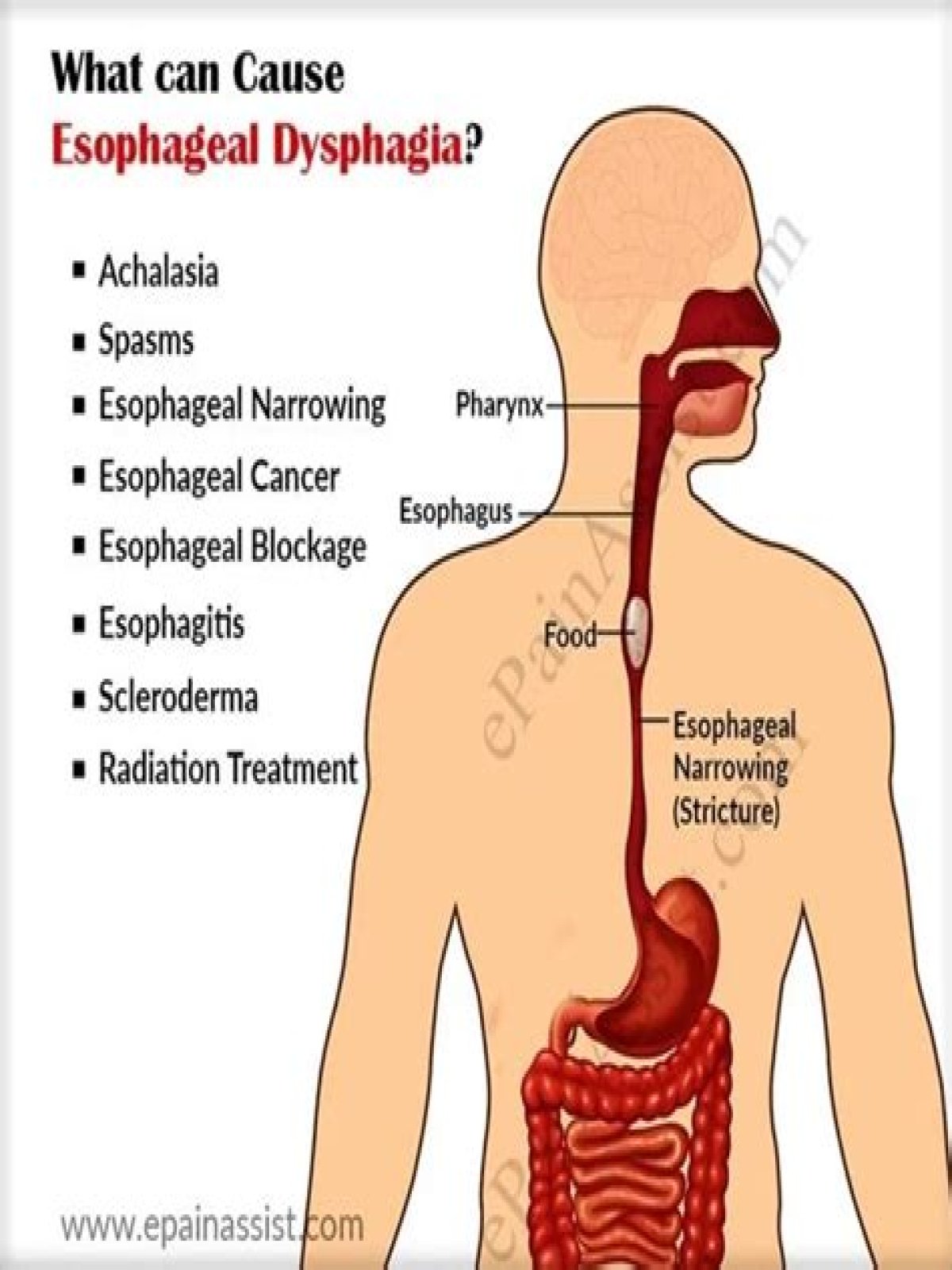 Why does my esophagus hurt when I eat